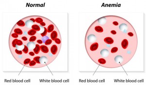 anemia