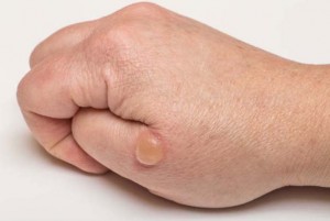 Blister