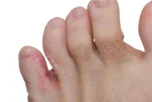Athlete's foot
