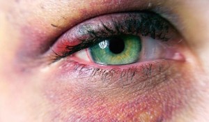 Home Remedies for Black Eye