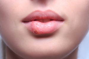 Cold Sore