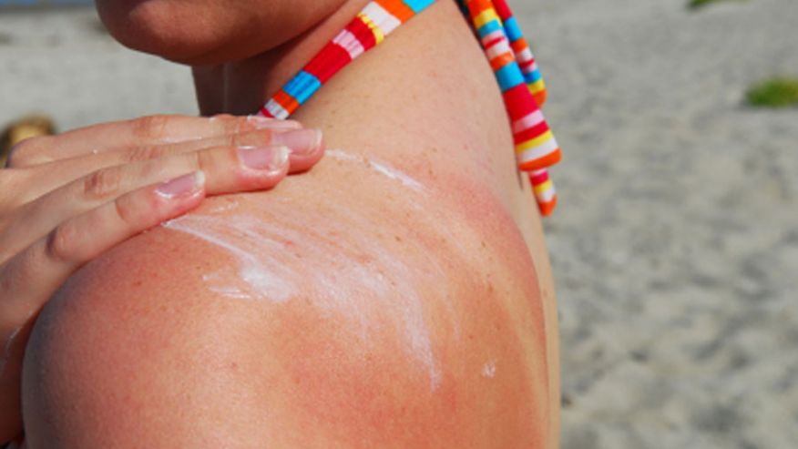 Home Remedies for Sunburn