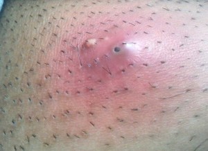 Abscess