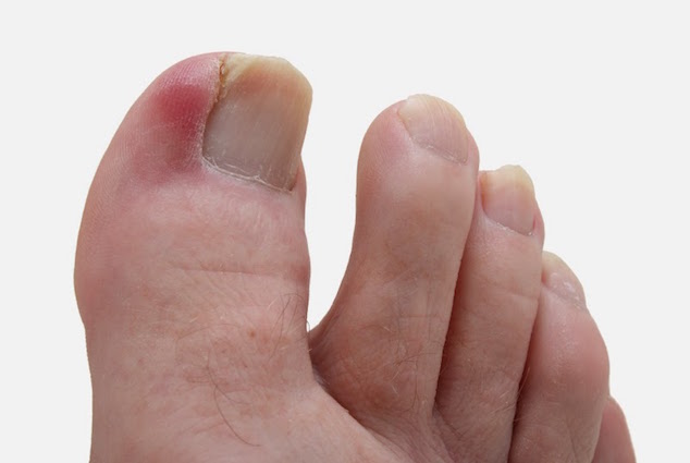 ingrown toenail