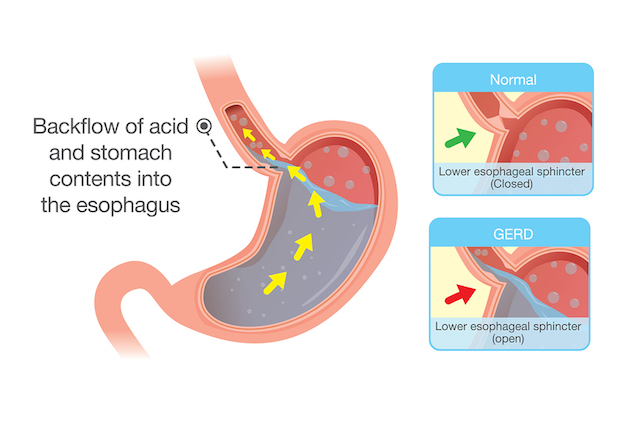 Acid Reflux/GERD