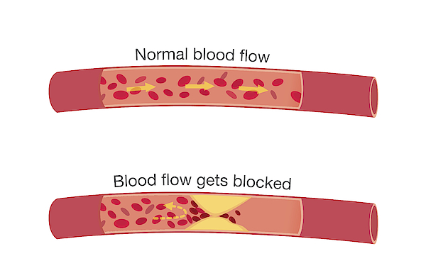 High Blood Cholesterol